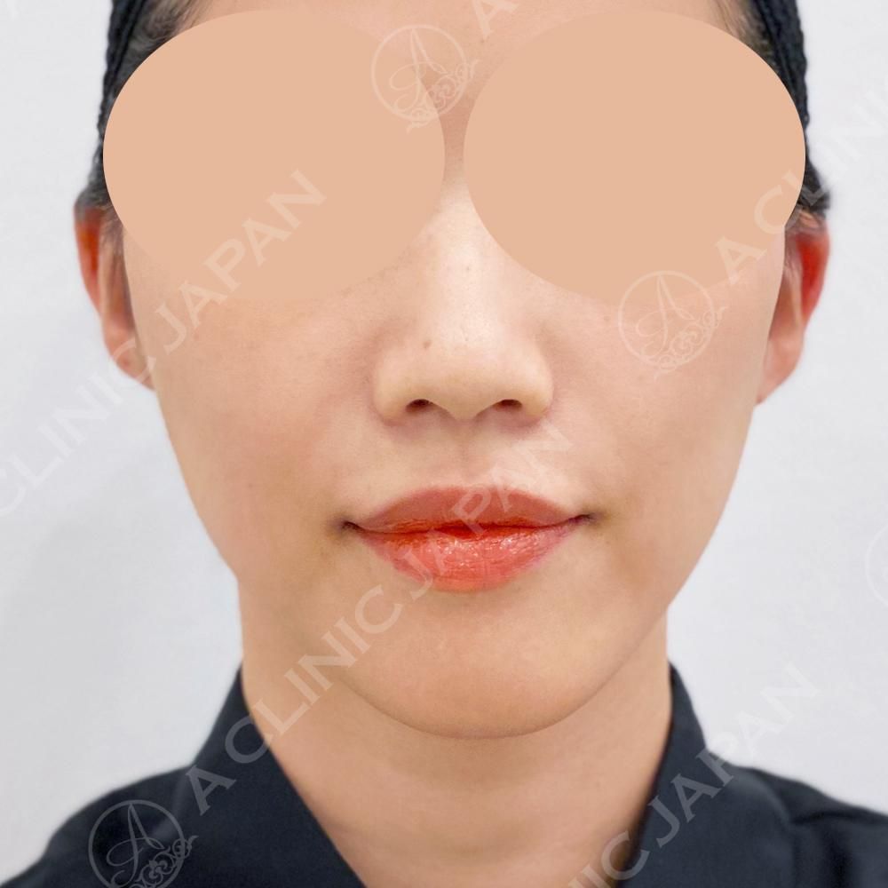 抜糸不要の切開リフトで自然にたるみを解消！A式美肌たるみ切開の処置前と3日後の症例です(30代女性) AFTER
