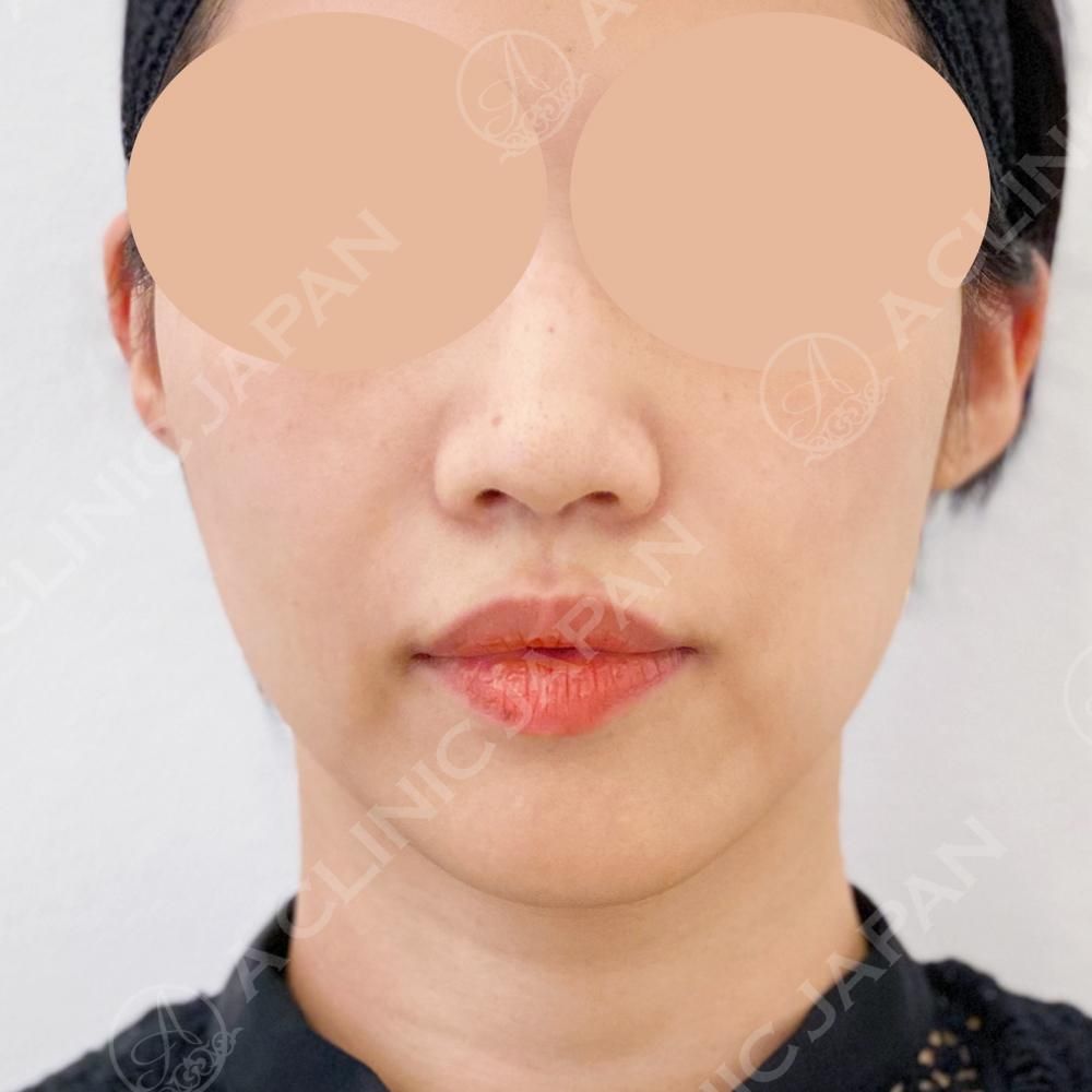 抜糸不要の切開リフトで自然にたるみを解消！A式美肌たるみ切開の処置前と3日後の症例です(30代女性) BEFORE
