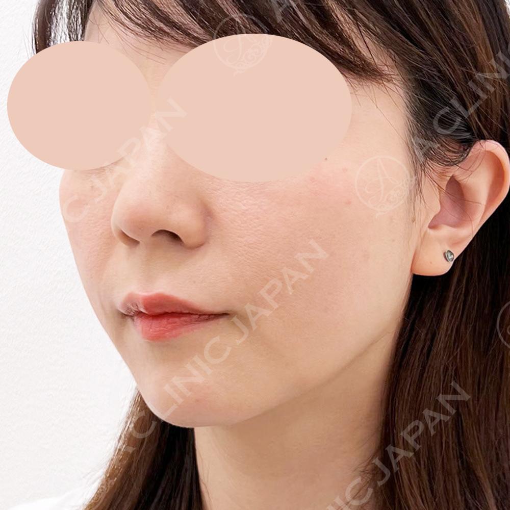 【傷跡の経過あり】切開リフトなのに抜糸不要で傷跡もほとんど目立ちません！A式美肌たるみ切開の処置前と1週間後の症例です(40代女性) BEFORE