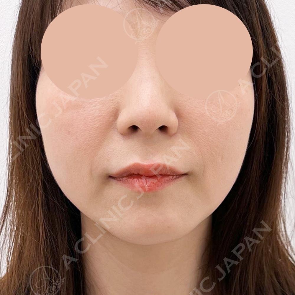 年齢によって気になってくるほうれい線や口横のたるみを撃退！A式美肌たるみ切開の処置前と処置直後の症例です(40代女性) BEFORE