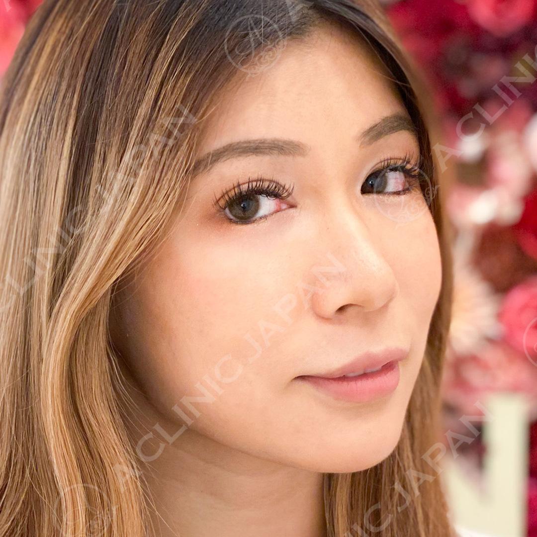 パーフェクトアイズでお目元が華やかになりお顔がさらに優しい印象に♪こちら処置前と2週間後の症例です(20代女性) AFTER