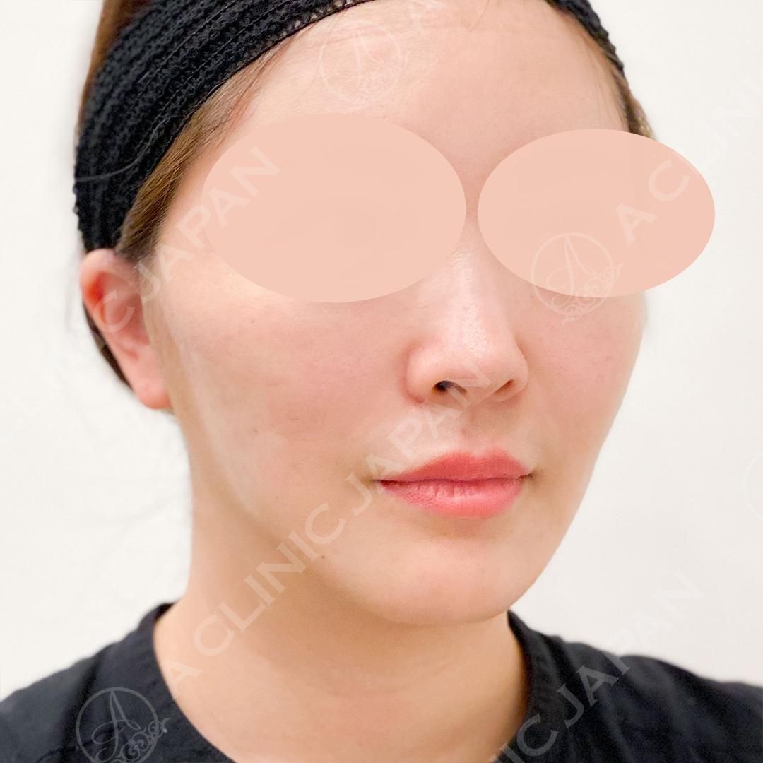 切開リフトとAスレッドを組み合わせた最強のリフトアップ術！A式美肌たるみ切開の処置前と処置直後の症例です(30代女性) AFTER