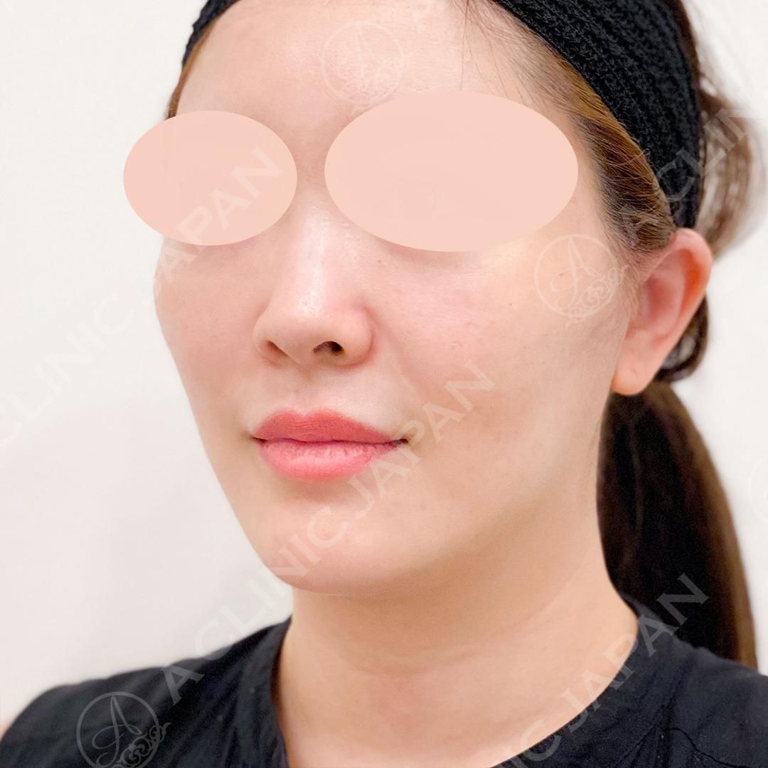 たるみを根本から改善！Aスレッドでは物足りない方におすすめのA式美肌たるみ切開の処置前と処置直後の症例です(30代女性) AFTER