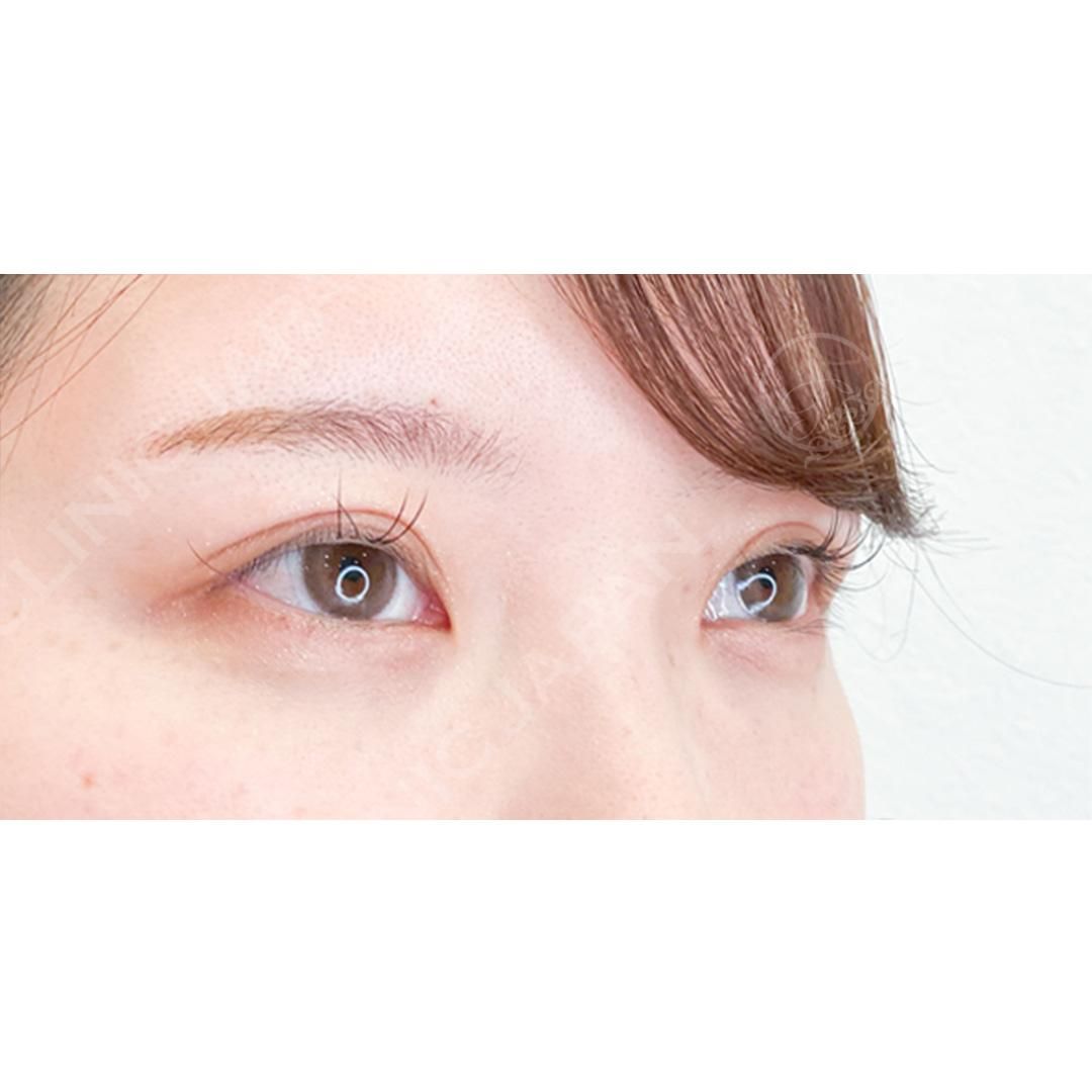 二重術埋没法で二重幅が広がり優しい印象に♪処置前と2週間後の症例です(20代女性) AFTER