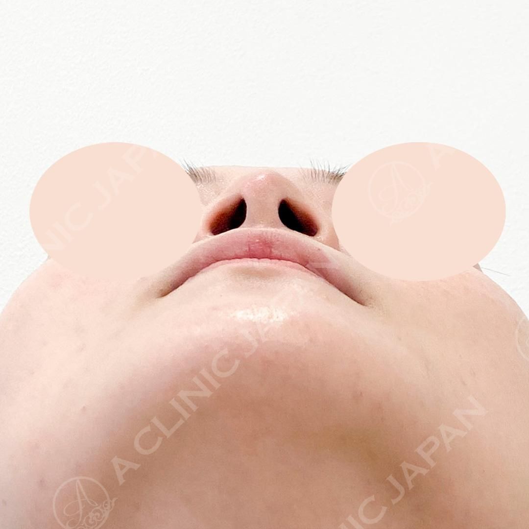 ナチュラルでツンとした鼻先に♪耳介軟骨移植(鼻尖形成)の処置前と1週間後の症例です(20代女性) AFTER