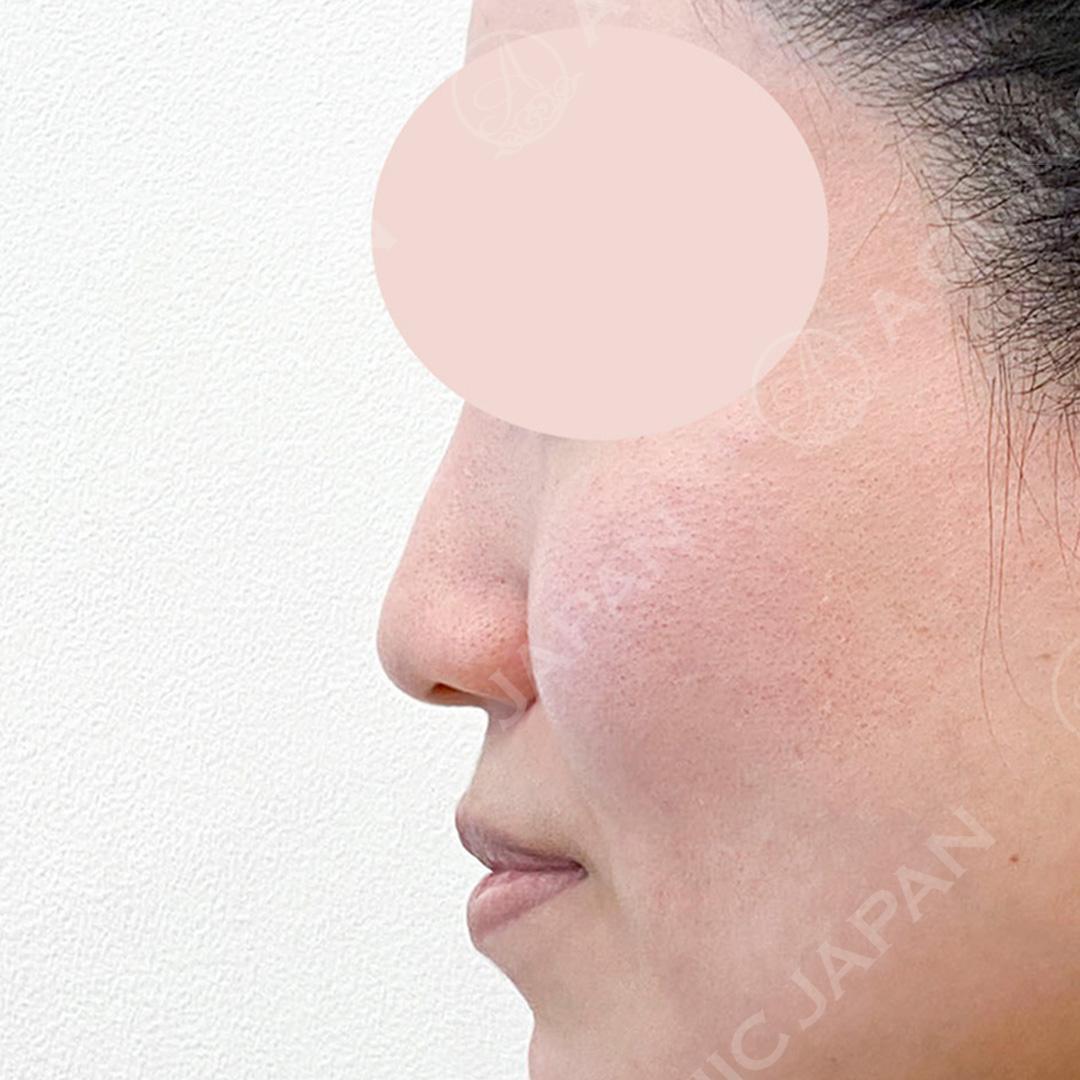 鼻先を自然に前に出したい♪耳介軟骨移植(鼻尖形成)の処置前と3週間後の症例です(20代女性) BEFORE