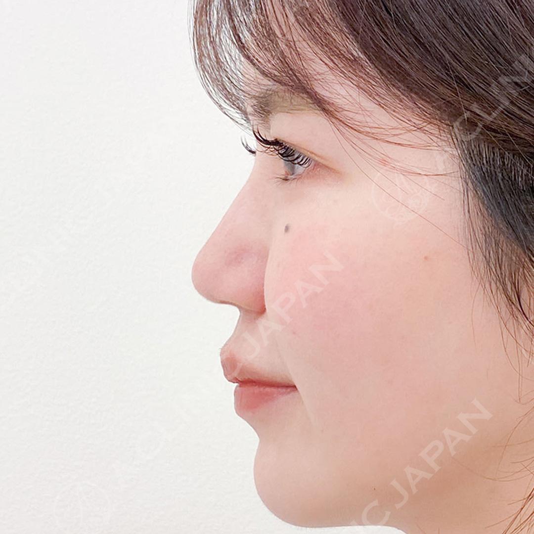 鼻先に高さが出ると横顔が美しく整います♪耳介軟骨移植(鼻尖形成)の処置前と1ヶ月後の症例です(20代女性) AFTER