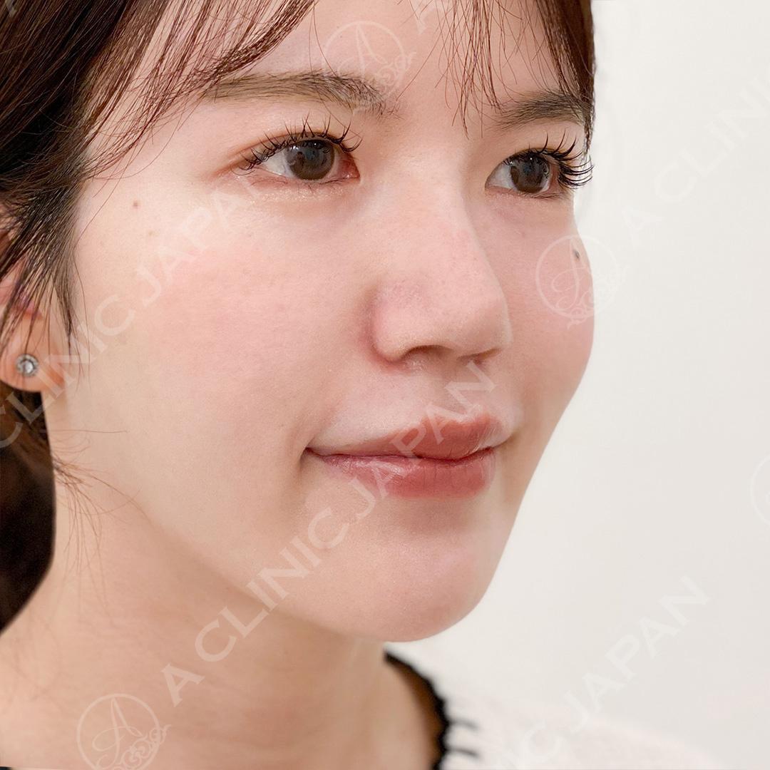 耳介軟骨移植(鼻尖形成)は傷跡も目立ちにくくバレにくい！処置前と1ヶ月後の症例です(20代女性) AFTER
