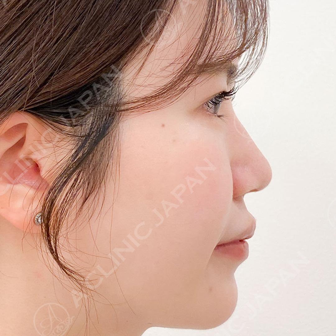 耳介軟骨移植(鼻尖形成)で半永久的に美しいお鼻に！処置前と1ヶ月後の症例です(20代女性) AFTER