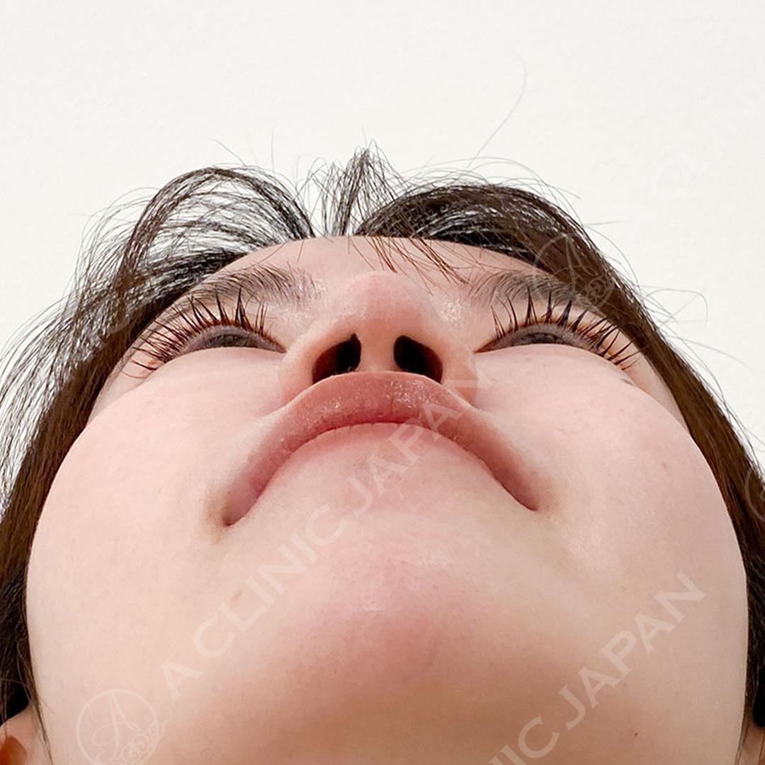 だんご鼻を改善しツンと美しい鼻先へ！耳介軟骨移植(鼻尖形成)の処置前と1ヶ月後の症例です(20代女性) AFTER