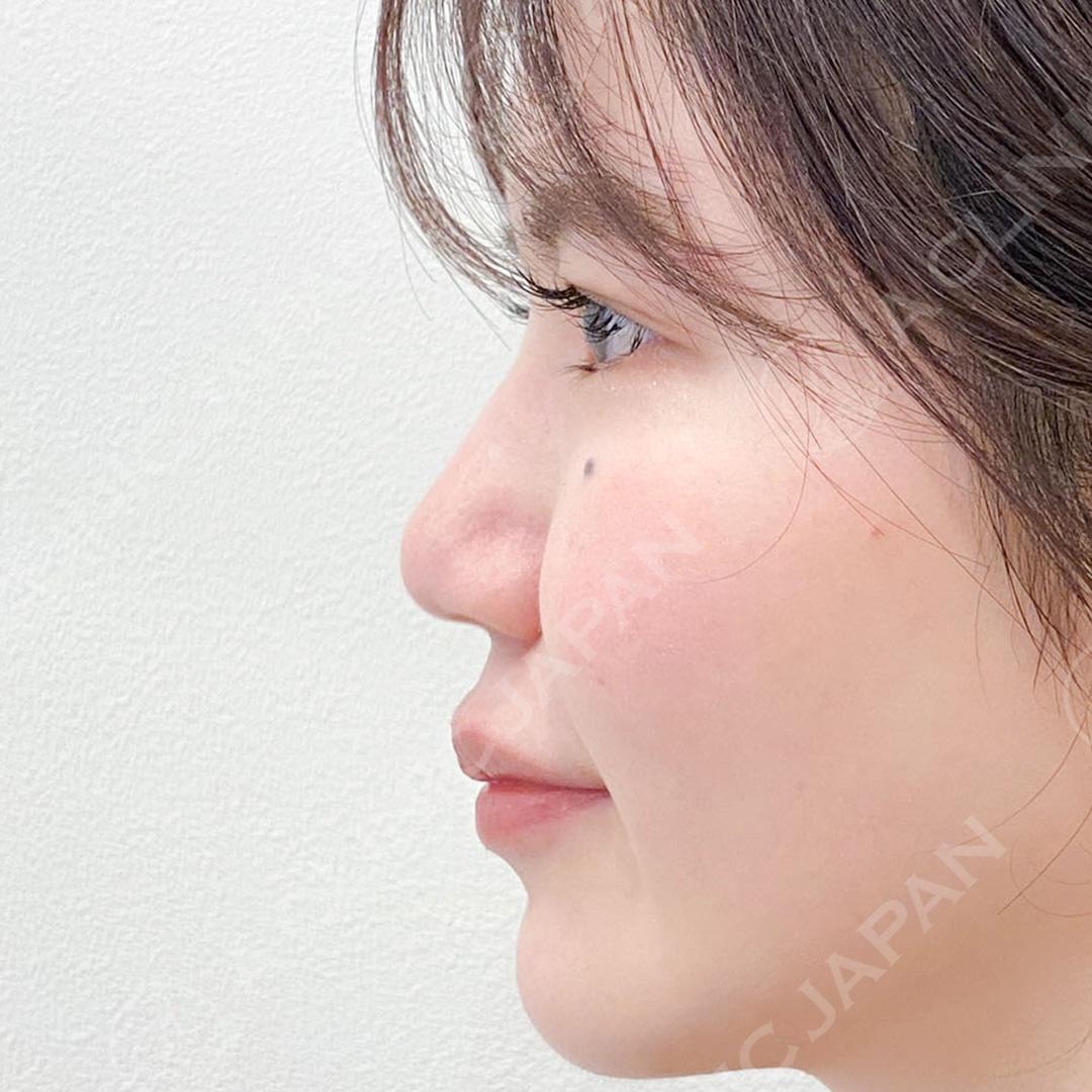 鼻先に高さが出ると横顔が美しく整います♪耳介軟骨移植(鼻尖形成)の処置前と1ヶ月後の症例です(20代女性) BEFORE