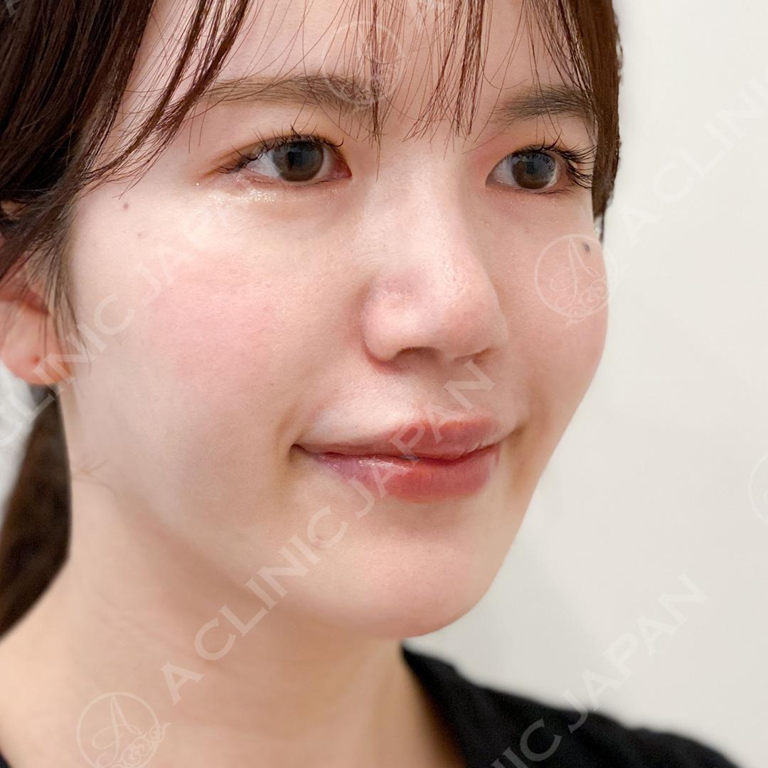 耳介軟骨移植(鼻尖形成)は傷跡も目立ちにくくバレにくい！処置前と1ヶ月後の症例です(20代女性) BEFORE