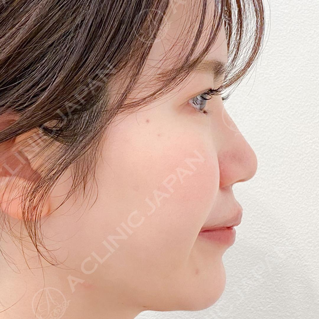 耳介軟骨移植(鼻尖形成)で半永久的に美しいお鼻に！処置前と1ヶ月後の症例です(20代女性) BEFORE