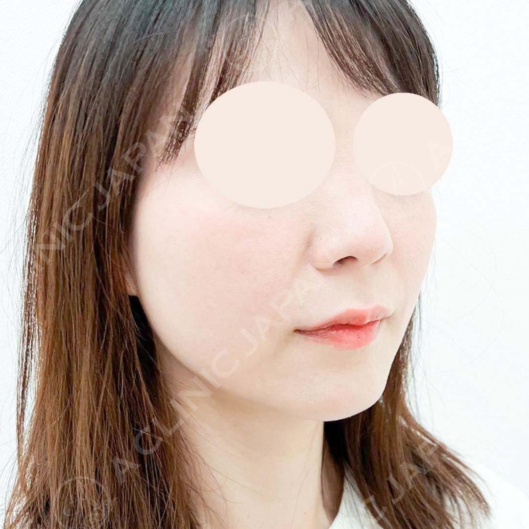 A式美肌たるみ切開で余分なたるみを除去したことによりフェイスラインがすっきり整いました！処置前と処置直後の症例です(40代女性) BEFORE