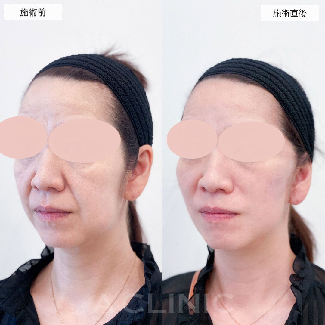 Aスレッドだけでは物足りない方に！A式美肌たるみ切開の処置前と処置直後の症例です(40代女性)