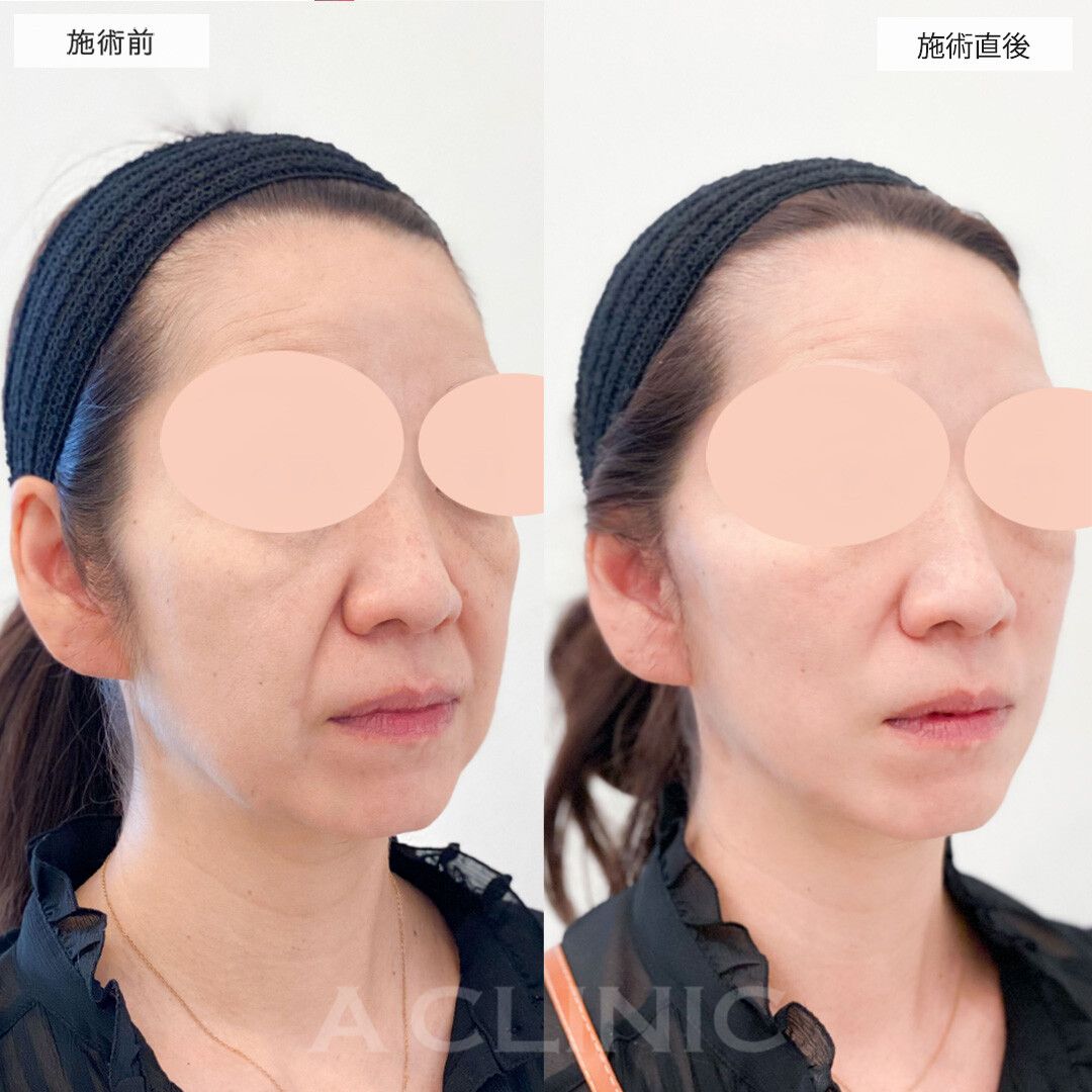 Aスレッドだけでは物足りない方に！A式美肌たるみ切開の処置前と処置直後の症例です(40代女性)