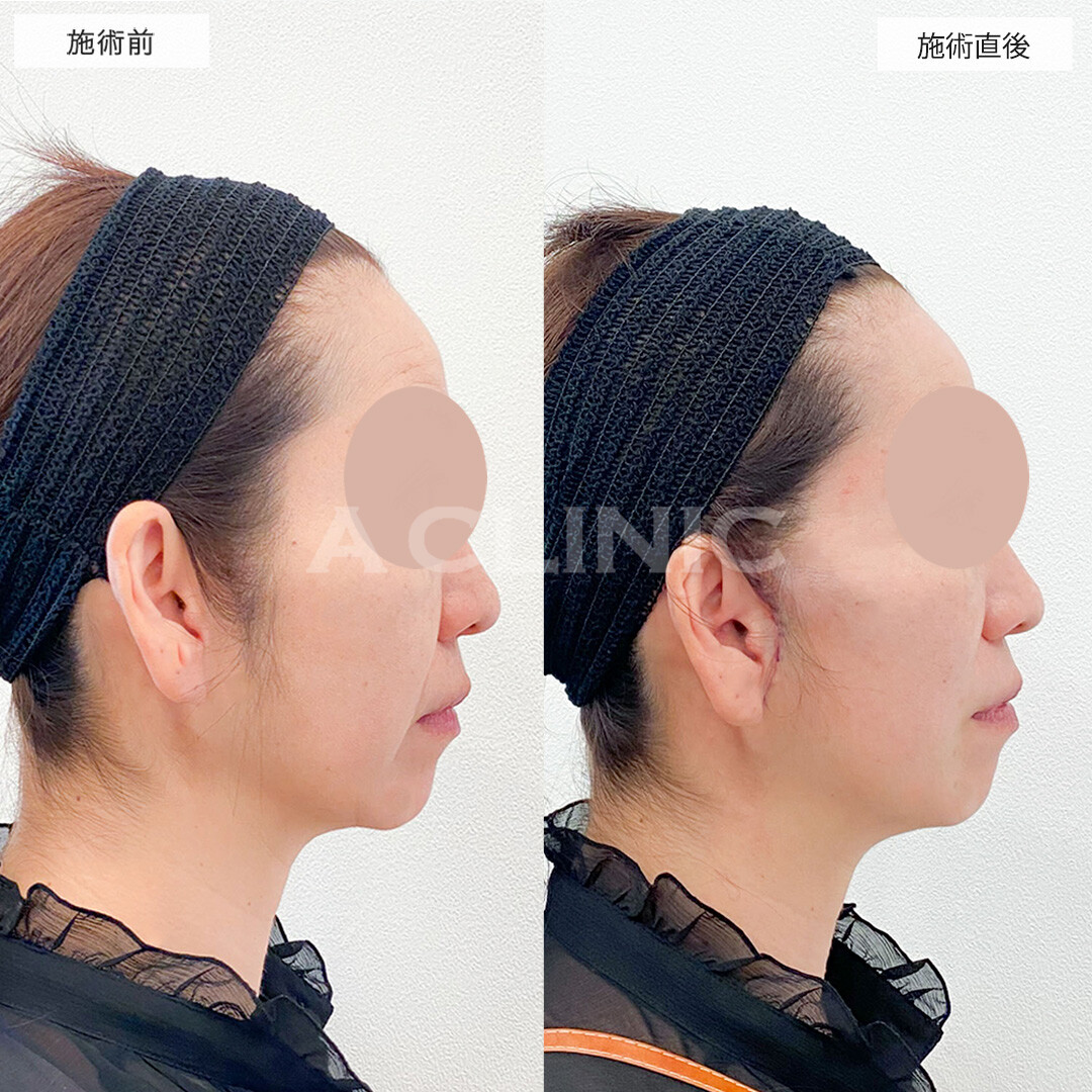 Aスレッドだけでは物足りない方に！A式美肌たるみ切開の処置前と処置直後の症例です(40代女性)
