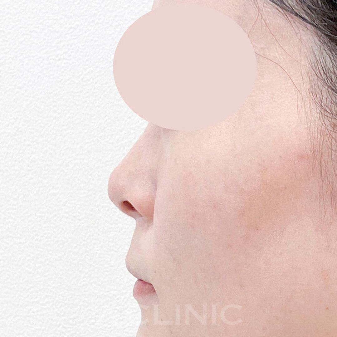 半永久的に鼻を高く出来る♪耳介軟骨移植(鼻尖形成)の処置前と1ヶ月後の症例です(20代女性) AFTER