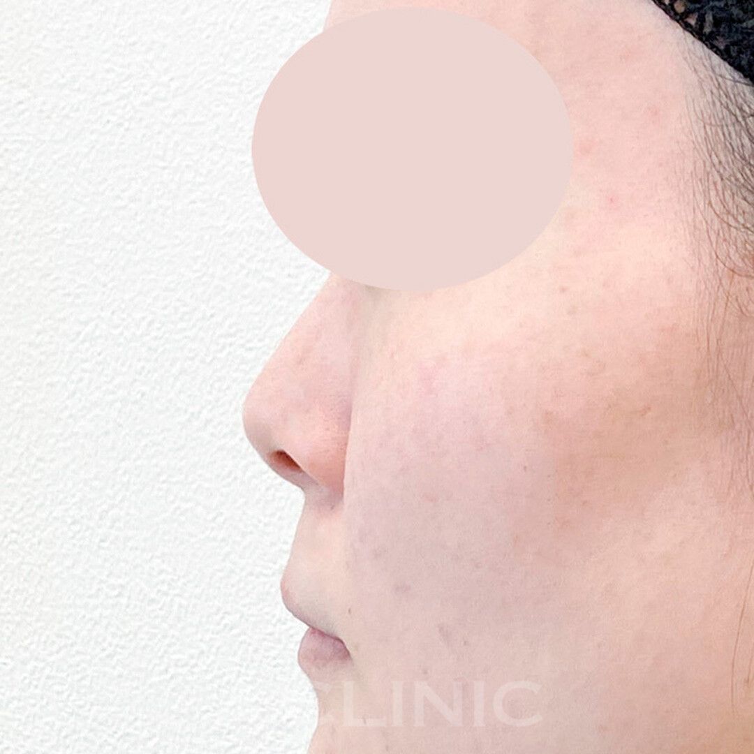 半永久的に鼻を高く出来る♪耳介軟骨移植(鼻尖形成)の処置前と1ヶ月後の症例です(20代女性) BEFORE
