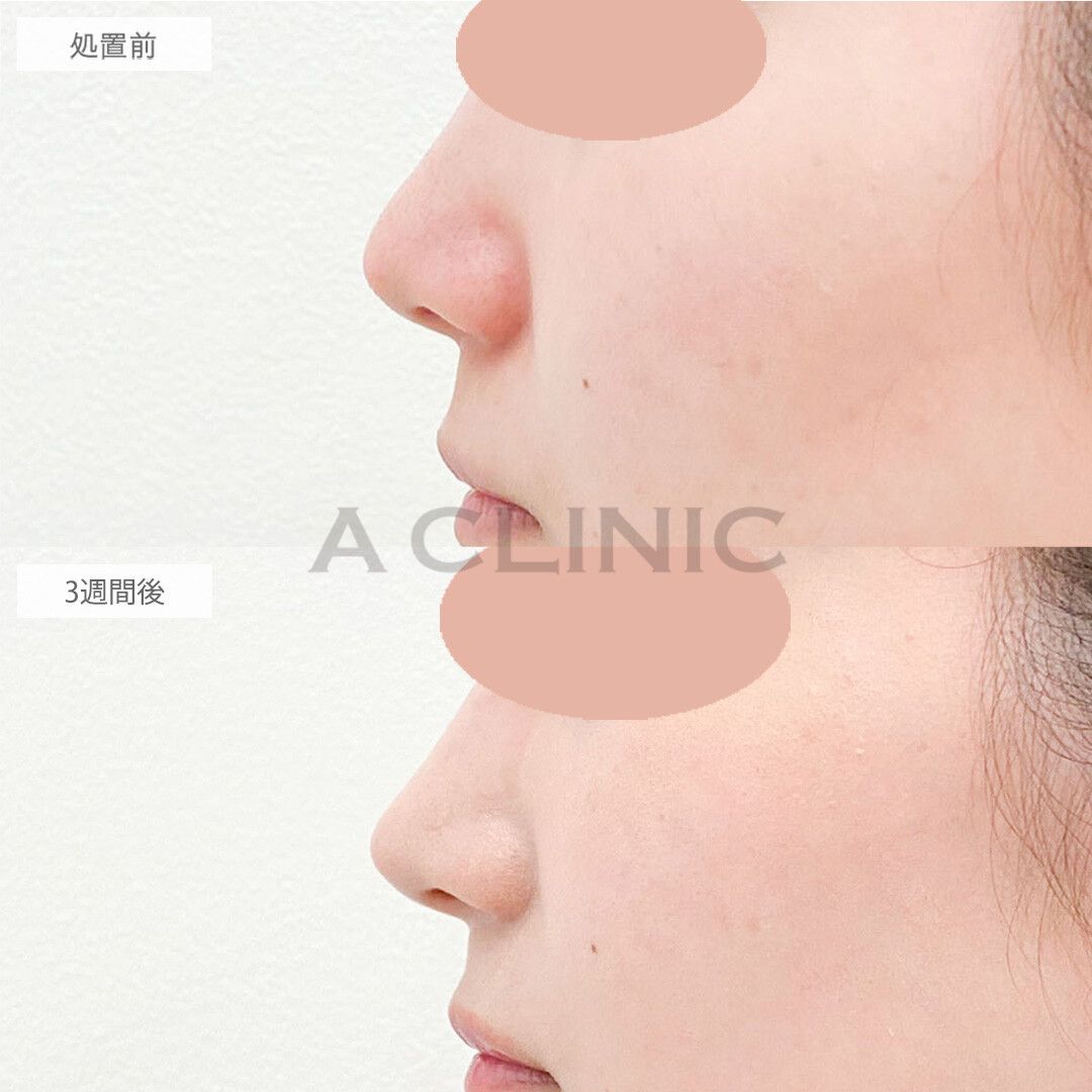 半永久的にツンとした高い鼻に。耳介軟骨移植(鼻尖形成)の処置前と3週間後の症例です(20代女性)