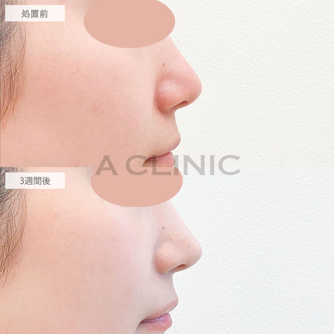 半永久的にツンとした高い鼻に。耳介軟骨移植(鼻尖形成)の処置前と3週間後の症例です(20代女性)