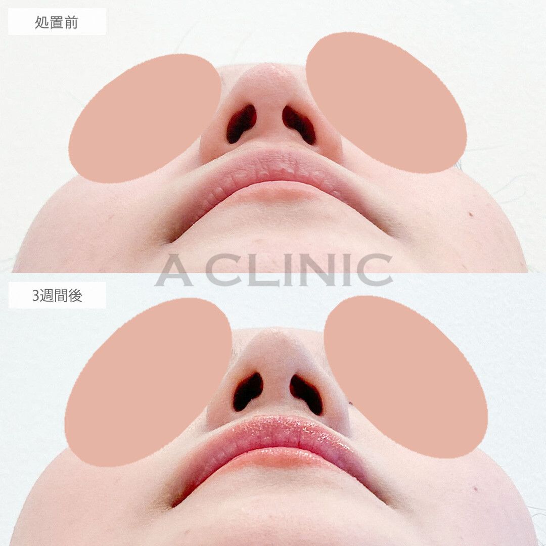 半永久的にツンとした高い鼻に。耳介軟骨移植(鼻尖形成)の処置前と3週間後の症例です(20代女性)