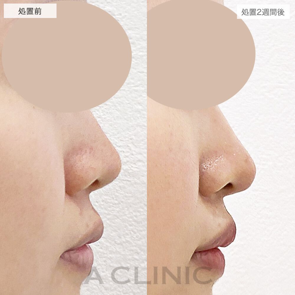 自然に鼻先を高く！耳介軟骨移植(鼻尖形成)と鼻先縮小術埋没法の処置前と2週間後の症例です(20代女性)
