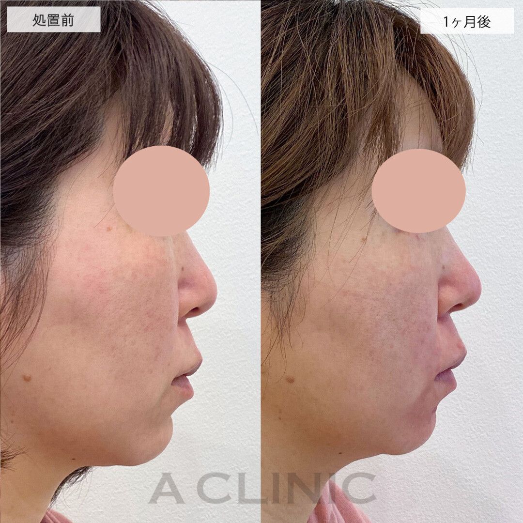 ツンとした鼻先が半永久的に手に入る！こちら耳介軟骨移植(鼻尖形成)の処置前と1ヶ月後の症例です(40代女性)