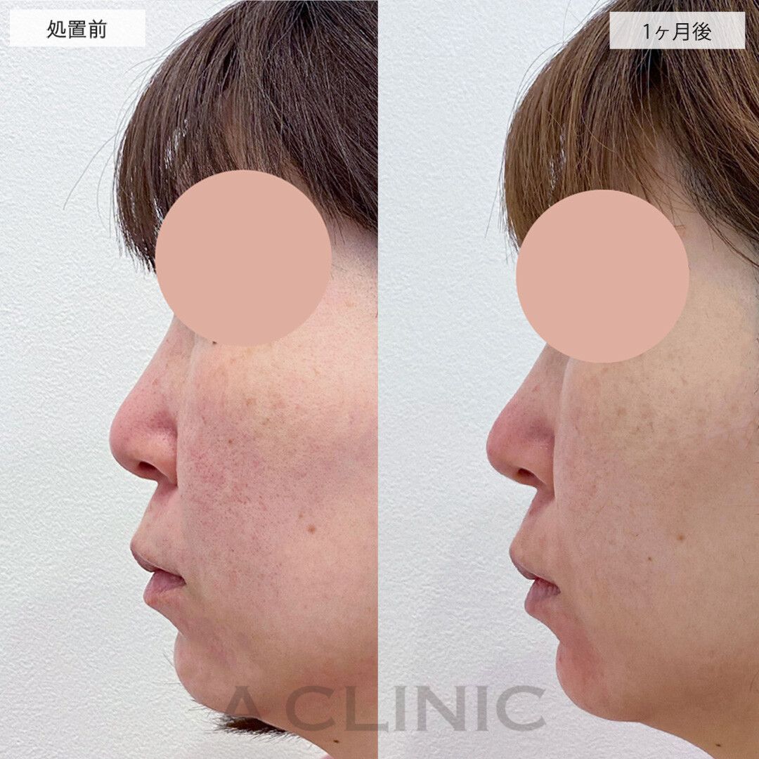 ツンとした鼻先が半永久的に手に入る！こちら耳介軟骨移植(鼻尖形成)の処置前と1ヶ月後の症例です(40代女性)