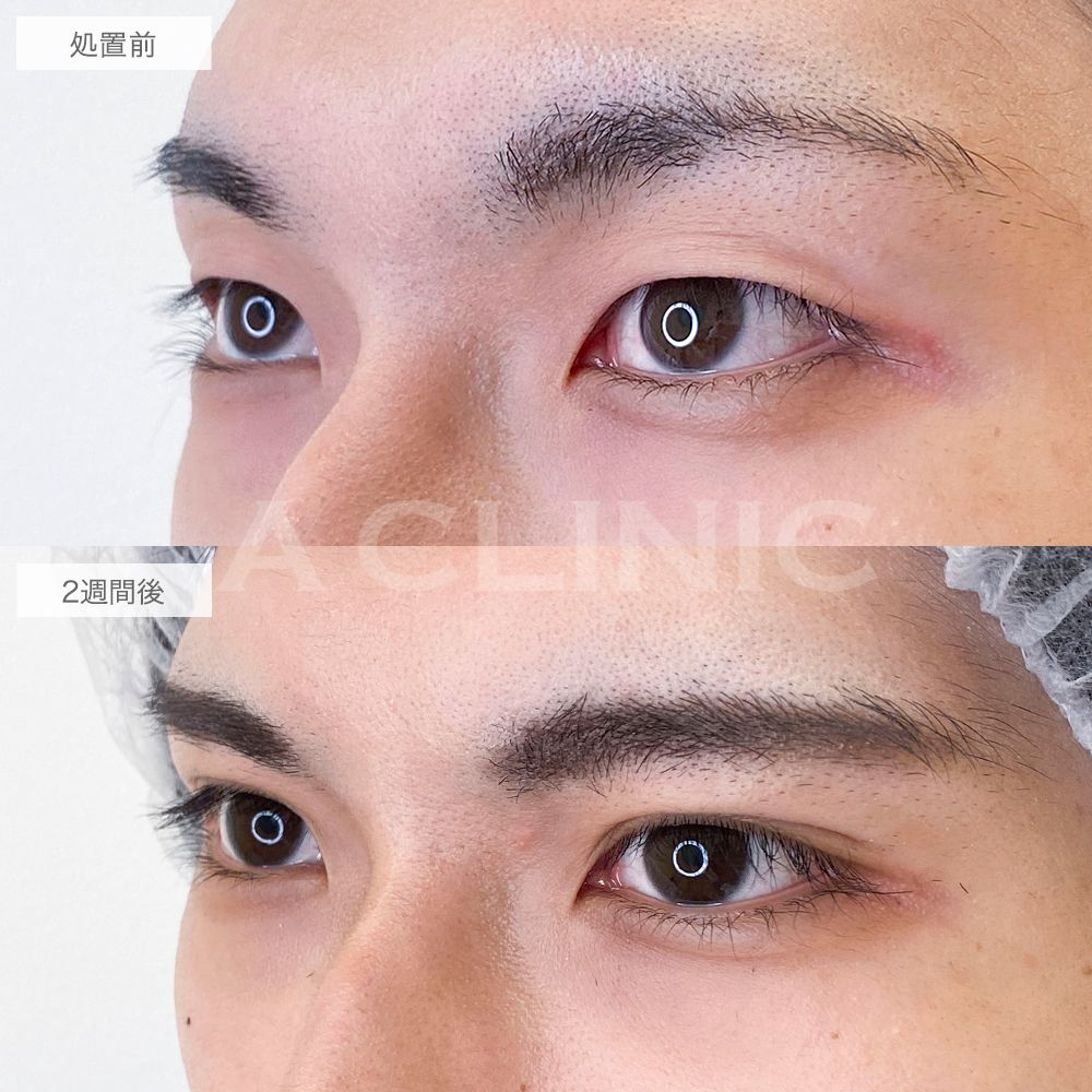 アイプチいらずの理想の二重に！二重術埋没法の処置前と2週間後の症例です(20代男性)