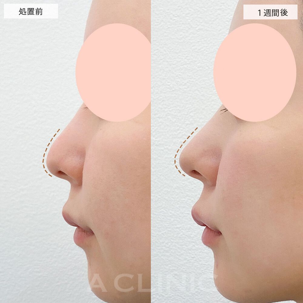 ツンとした鼻先で理想的なEラインに♪耳介軟骨移植(鼻尖形成)の処置前と1週間後の症例です(20代女性)