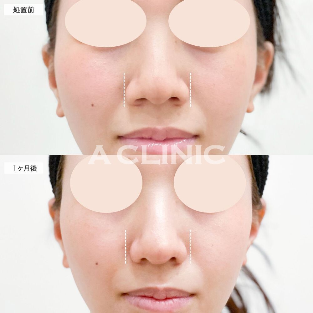 小鼻縮小術切開法と鼻尖形成（耳介軟骨）で鼻の広がりが解消しツンとした鼻に変化！処置前と1ヶ月後の症例です(20代女性)