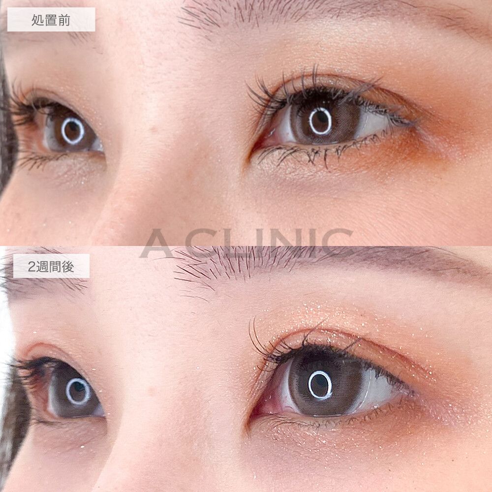 目の縦幅が広がりカラコンが映える華やかなお目元になりました！パーフェクトアイズの処置前と2週間後の症例です(30代女性)