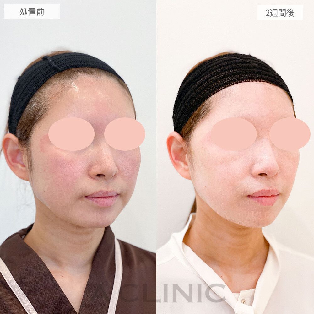【直後の傷跡あり】抜糸不要の切開リフト！ダウンタイムを最小限に抑えたA式美肌たるみ切開の処置前と2週間後の症例です(30代女性)