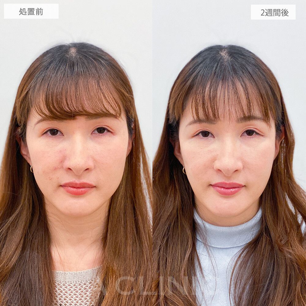 【直後の傷跡あり】抜糸不要の切開リフトと強力な糸リフトAスレッドを1回で♪こちらA式美肌たるみ切開の処置前と2週間後の症例です(30代女性)