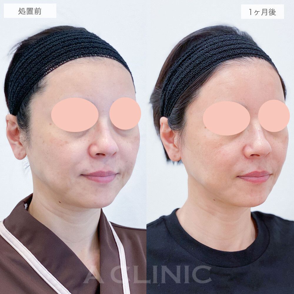【直後の傷跡あり】A式美肌たるみ切開で頬のもたつきが改善されてスッキリ小顔になりました！処置前と1ヶ月後の症例です(40代女性)