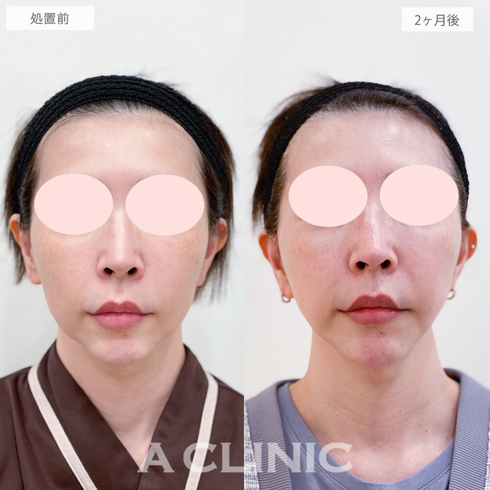 【直後の傷跡あり】切開リフトなのに抜糸不要で傷跡もほとんど目立ちません！A式美肌たるみ切開の処置前と2ヶ月後の症例です(40代女性)
