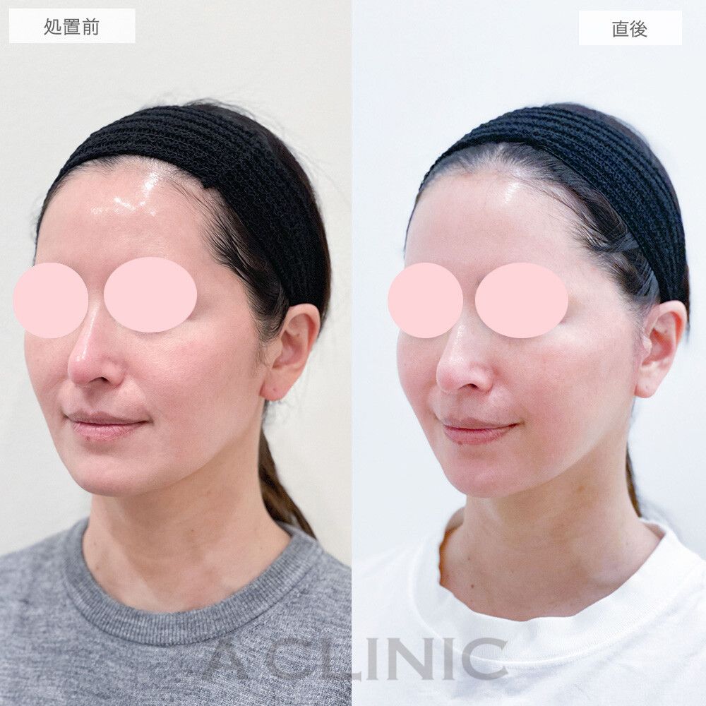 【直後の傷跡あり】A式美肌たるみ切開で頬のもたつきが改善されてスッキリした印象に！処置前と1ヶ月後の症例です(40代女性)