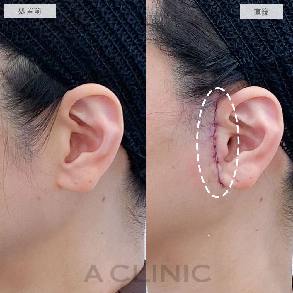 【直後の傷跡あり】A式美肌たるみ切開で頬のもたつきが改善されてスッキリ小顔になりました！処置前と1ヶ月後の症例です(40代女性)