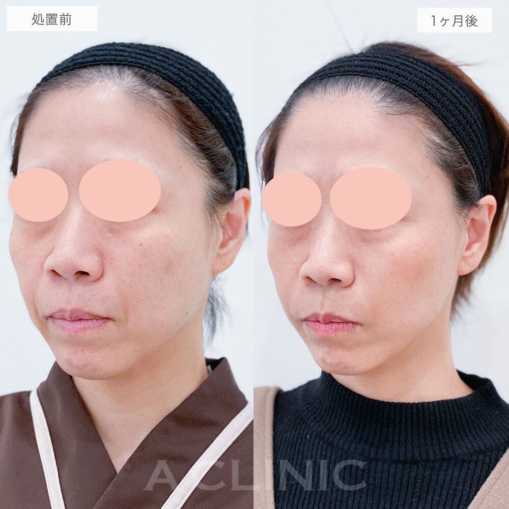 【直後の傷跡あり】気になるほうれい線や口横のたるみを撃退！A式美肌たるみ切開の処置前と1ヶ月後の症例です(40代女性)
