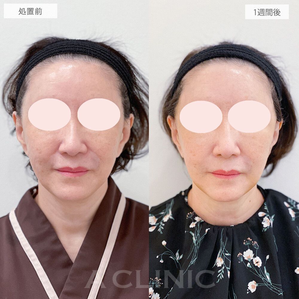 【直後の傷跡あり】抜糸不要の切開リフトと強力な糸リフトがセットになった施術でほうれい線が薄くなりました♪こちらA式美肌たるみ切開の処置前と1週間後の症例です(60代女性