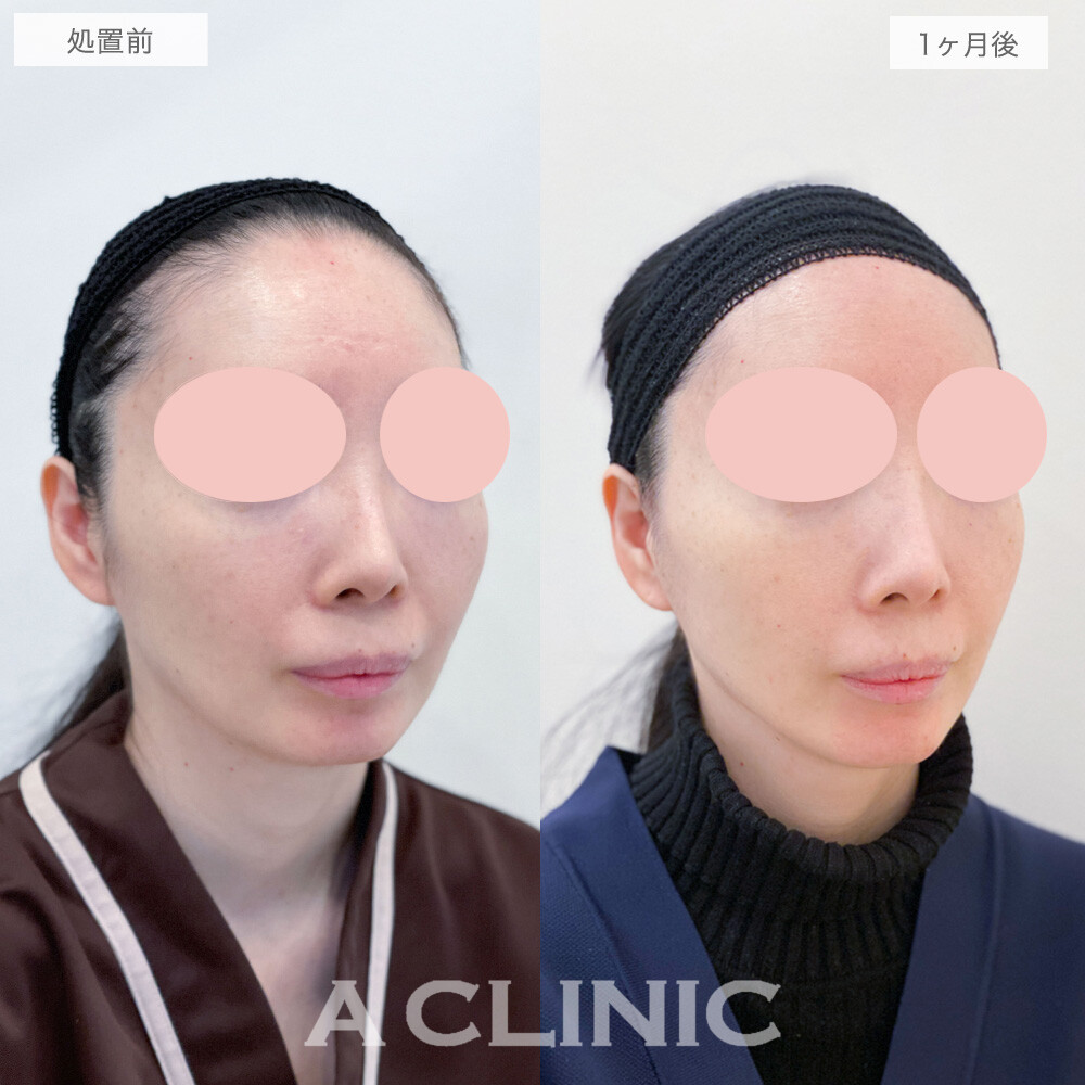 【直後の傷跡あり】A式美肌たるみ切開でたるみの改善！A式美肌たるみ切開の処置前と1ヶ月後の症例です(40代女性)