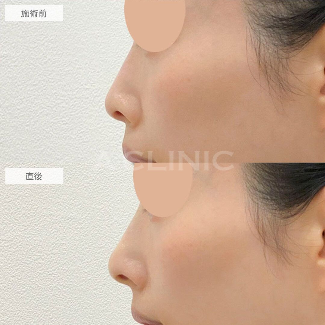 注入だけで鼻のトータルデザインが可能！ジャスミンノーズの処置前と直後の症例です(30代女性)