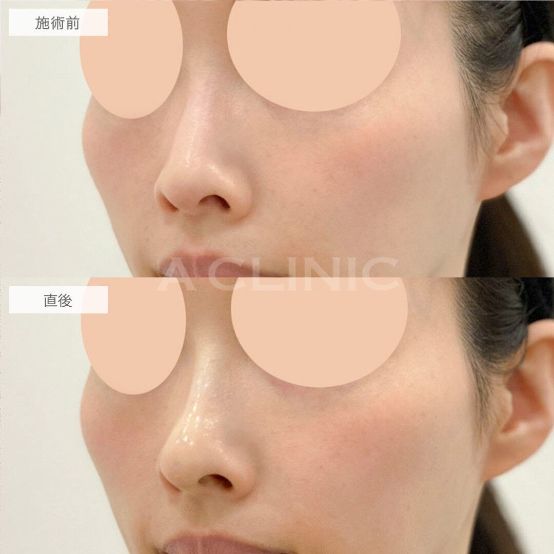 注入だけで鼻のトータルデザインが可能！ジャスミンノーズの処置前と直後の症例です(30代女性)