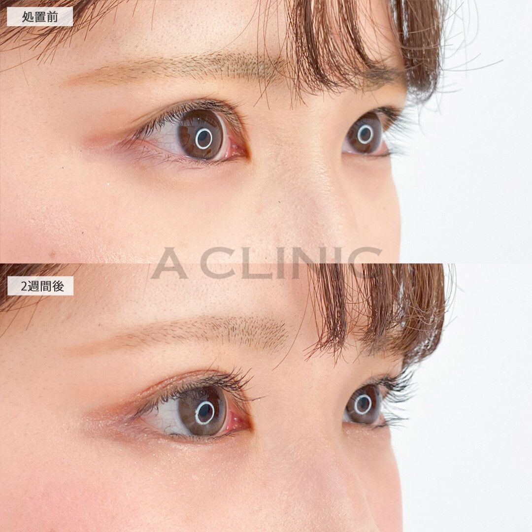 たれ目になることで可愛らしい印象のお目元に！パーフェクトアイズの処置前と2週間後の症例です(20代女性)