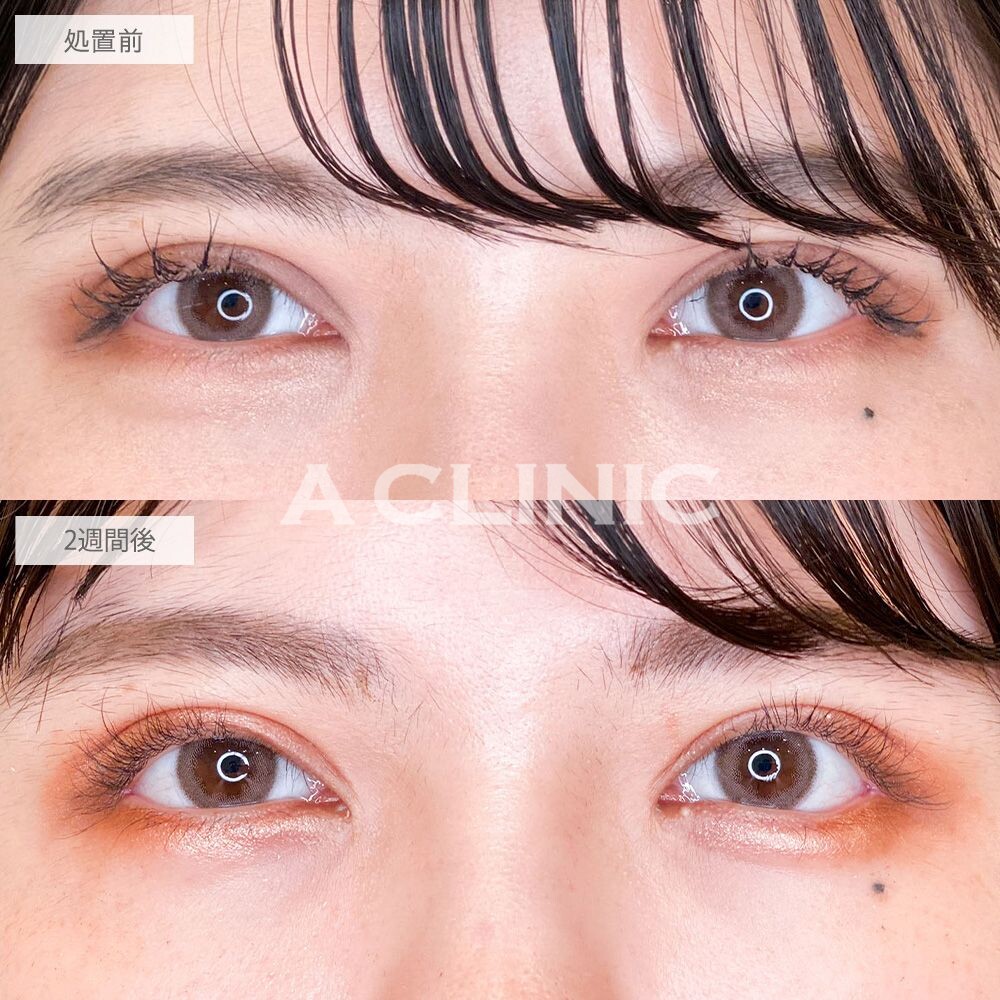 パーフェクトアイズでナチュラルなタレ目に変化！処置前と2週間後の症例です(20代女性)