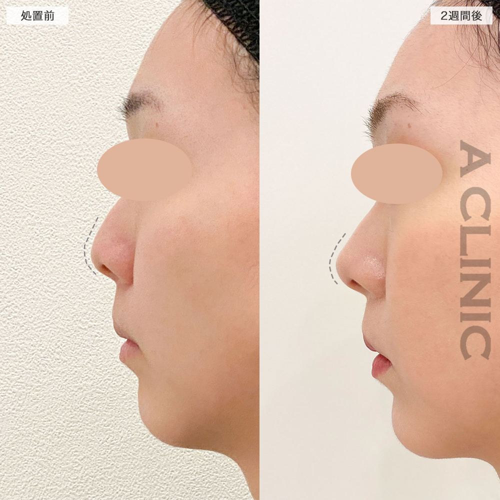 半永久的に理想的なＥラインが叶う！耳介軟骨移植(鼻尖形成)の処置前と2週間後の症例です(20代女性)