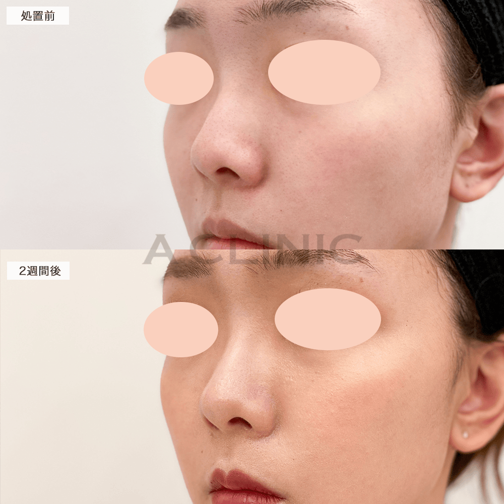 半永久的に理想的なＥラインが叶う！耳介軟骨移植(鼻尖形成)の処置前と2週間後の症例です(20代女性)