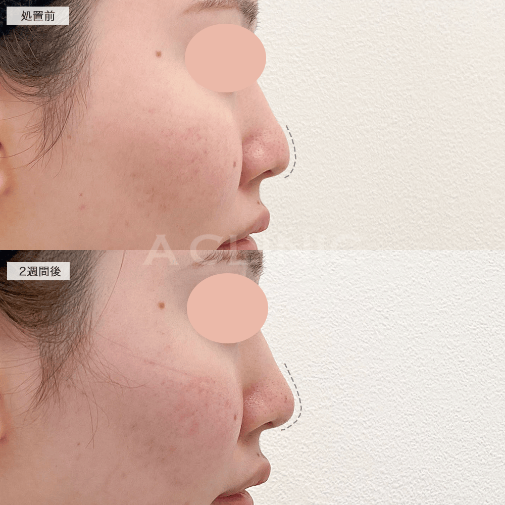 半永久的な効果で理想的なお鼻の高さに！耳介軟骨移植(鼻尖形成)の処置前と2週間後の症例です(20代女性)