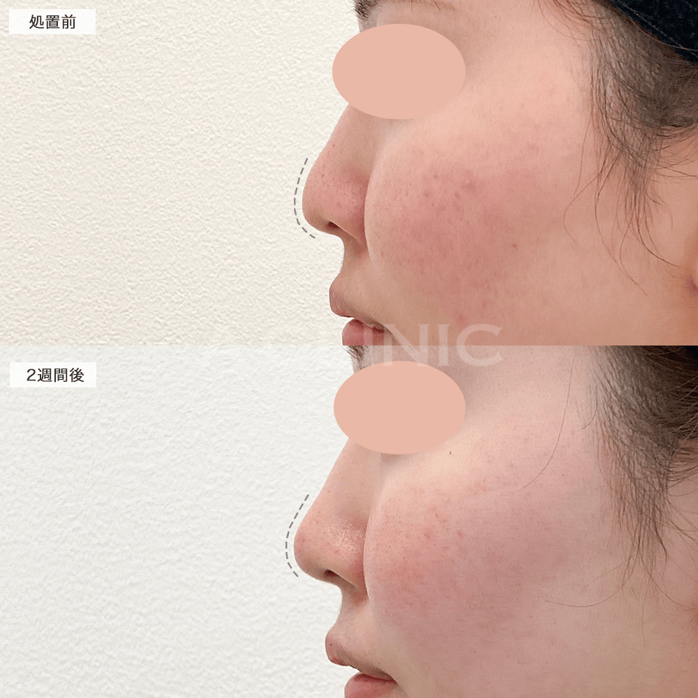 半永久的な効果で理想的なお鼻の高さに！耳介軟骨移植(鼻尖形成)の処置前と2週間後の症例です(20代女性)
